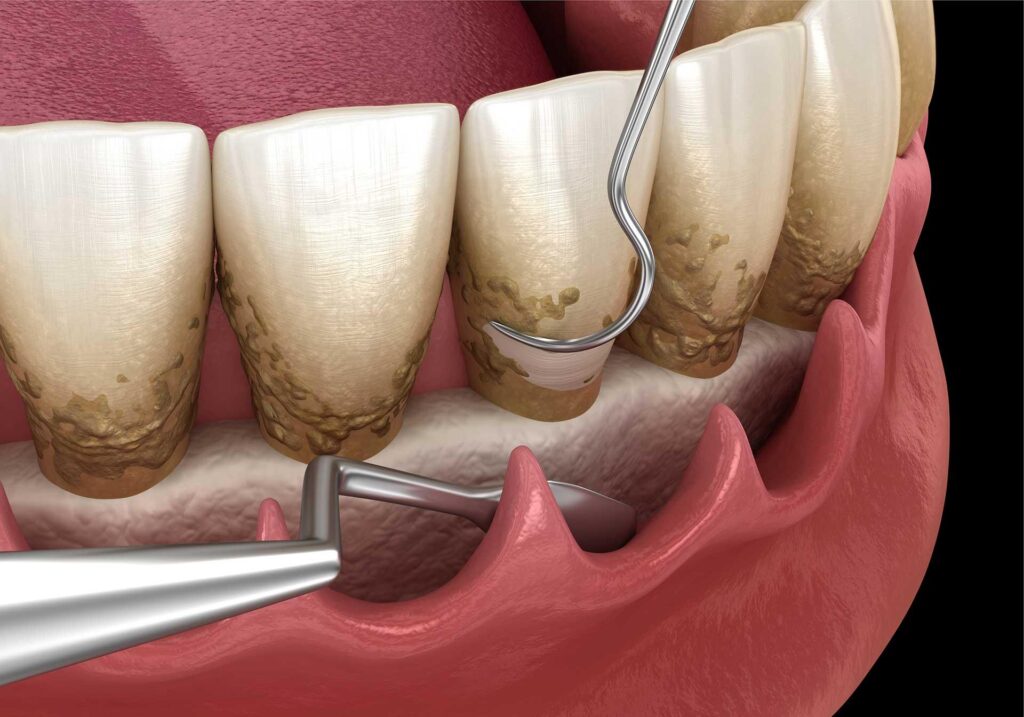 deep dental cleaning, signs of need for deep cleaning, dental cleaning symptoms, risks of periodontal disease, professional dental cleaning, gum health assessment, when to get deep cleaning, oral health symptoms, dentist deep cleaning treatment, periodontal therapy