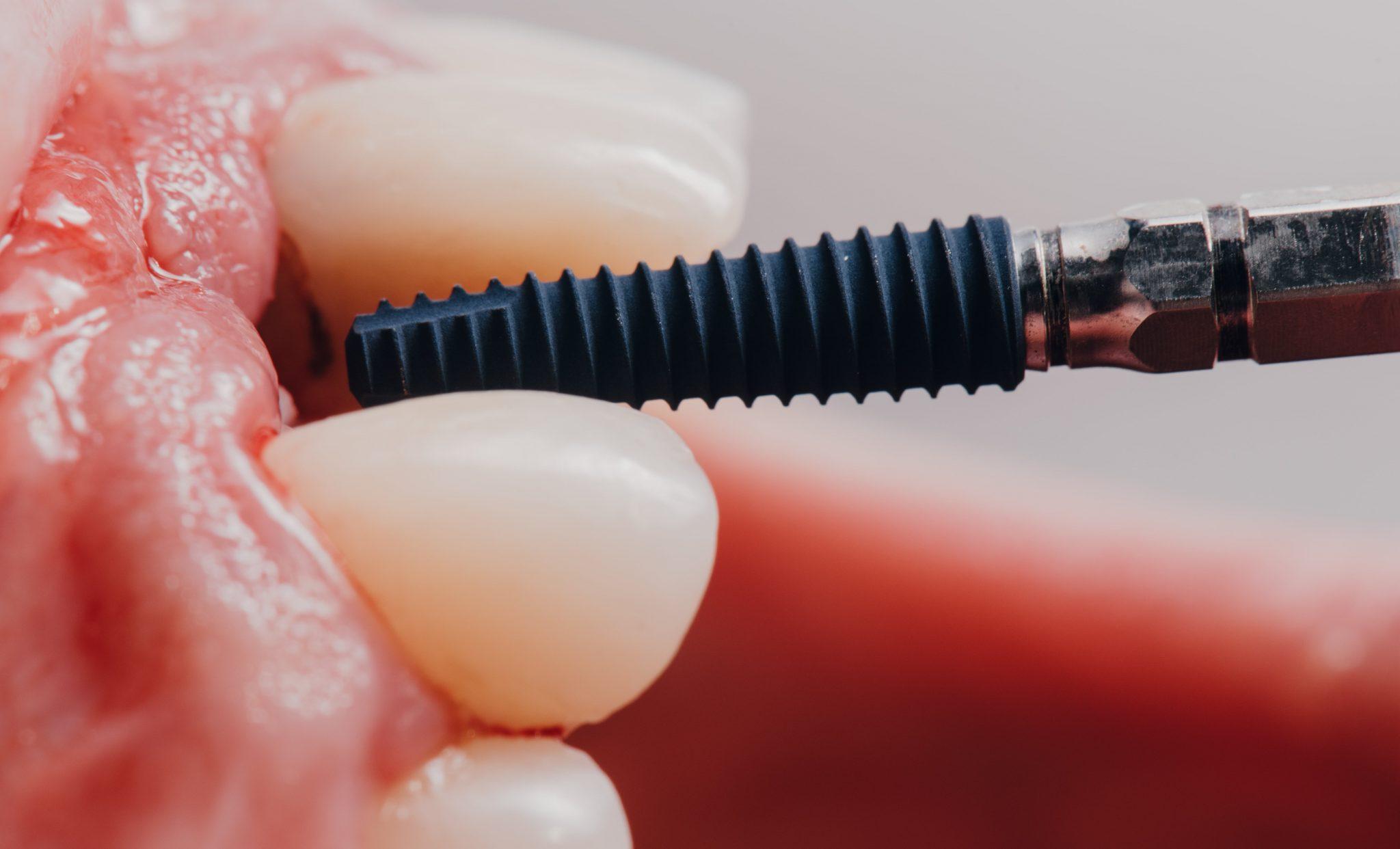 osseointegration process, dental osseointegration steps, implant integration timeline, dental implant healing, how osseointegration works, implant surgery recovery, titanium implant integration, dental implant procedure guide, implant success factors, osseointegration overview