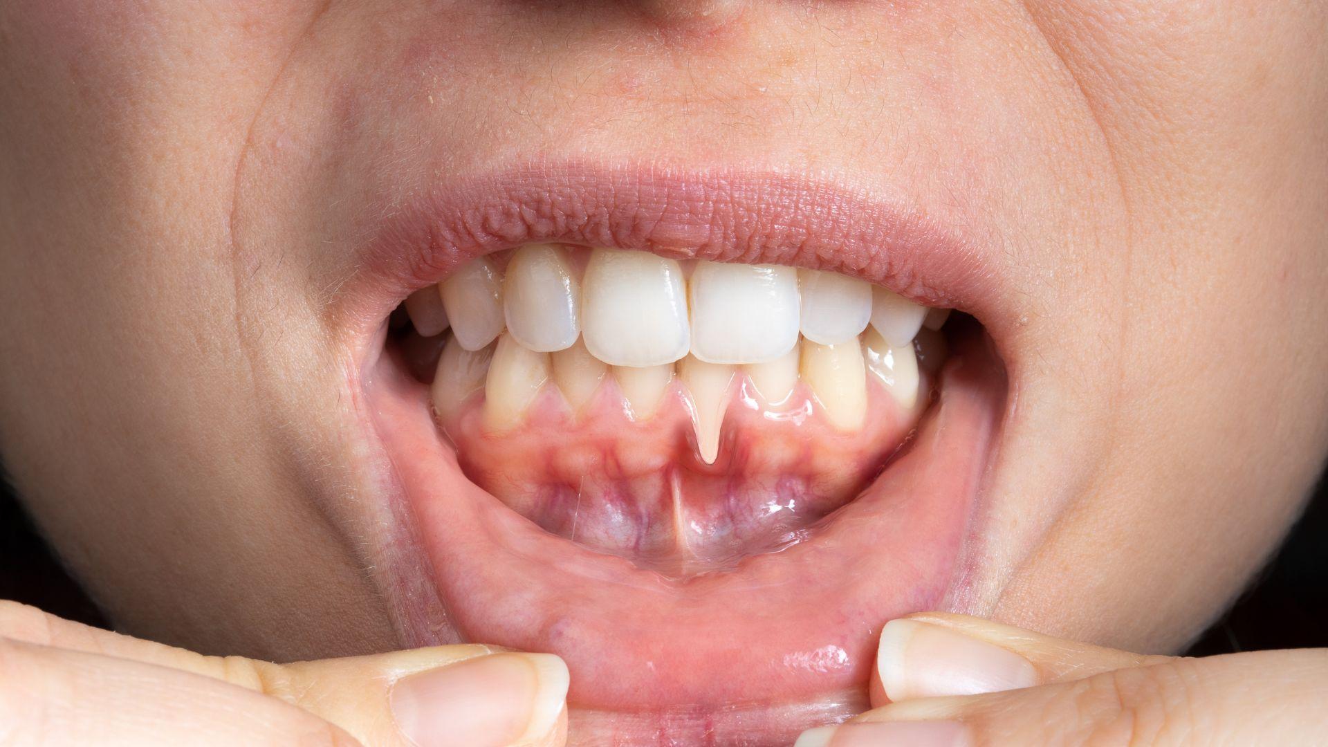 receding gums causes, gum recession treatment, prevent receding gums, reversing gum recession, gum health tips, gum disease solutions, sensitive teeth relief, best gum treatment, gum recession remedies, receding gums treatment options