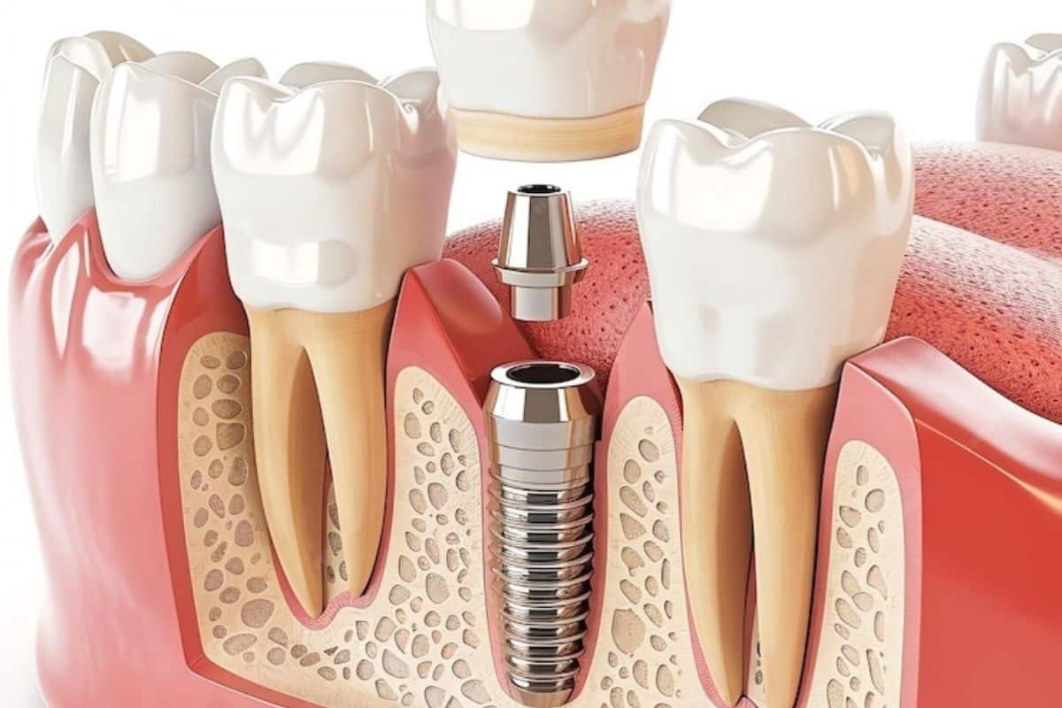 implant failure causes, bone fuse issues implant, symptoms of implant non-fusion, dental implant complication treatment, implant not integrating bone, dental implant failure symptoms, implant non-union remedies, dental implant fuse problems, failed dental implant care, implant osseointegration issues