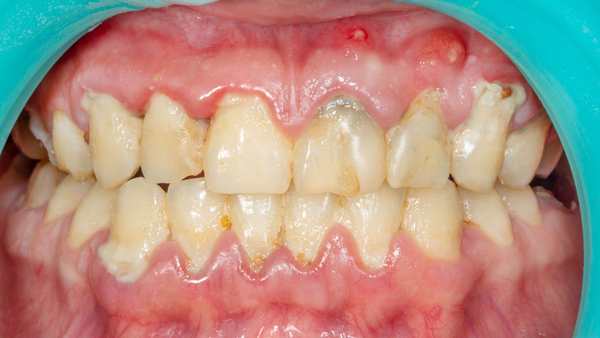 plaque buildup, tartar formation, cavity prevention, gum disease treatment, untreated plaque consequences, dental tartar removal, cavity risk factors, gum health issues, oral health complications, untreated dental plaque